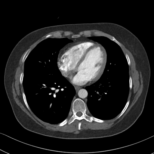 Chronic pulmonary embolus (Radiopaedia 39129-41341 Axial C+ CTPA 67).png