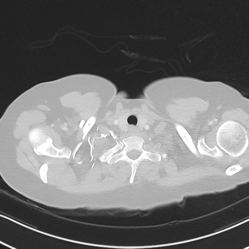 Chronic pulmonary embolus (Radiopaedia 39129-41341 Axial lung window 5).png