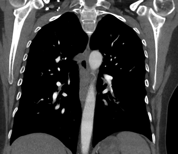 File:Chronic pulmonary embolus (Radiopaedia 39129-41341 Coronal C+ CTPA 53).png