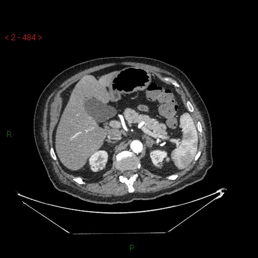 Circumaortic left renal vein and doubled left renal arteries (Radiopaedia 52268-58158 A 20).jpg
