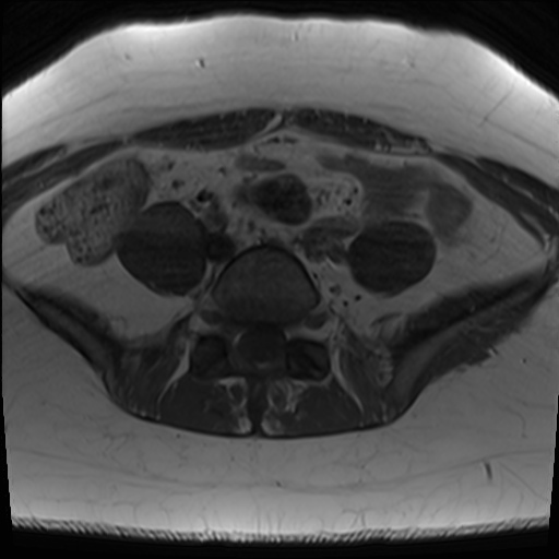File:Class II Mullerian duct anomaly- unicornuate uterus with rudimentary horn and non-communicating cavity (Radiopaedia 39441-41755 Axial T1 1).jpg