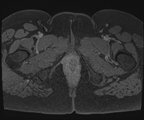 File:Class II Mullerian duct anomaly- unicornuate uterus with rudimentary horn and non-communicating cavity (Radiopaedia 39441-41755 Axial T1 fat sat 144).jpg