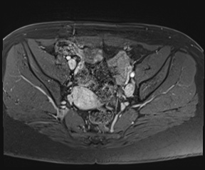 File:Class II Mullerian duct anomaly- unicornuate uterus with rudimentary horn and non-communicating cavity (Radiopaedia 39441-41755 Axial T1 fat sat 49).jpg