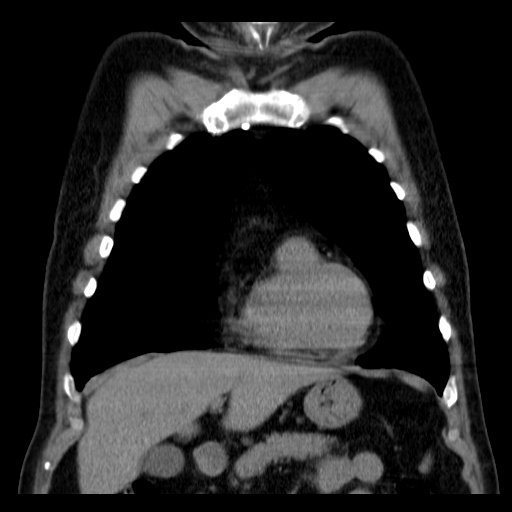 File:Classic complicated silicosis (Radiopaedia 49720-54961 Coronal liver window 15).jpg