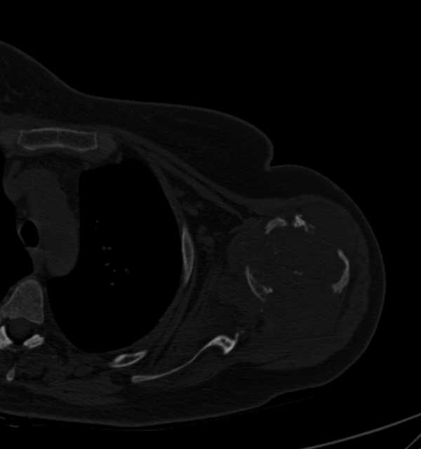 Clear cell chondrosarcoma - humerus (Radiopaedia 63104-71612 Axial bone window 50).jpg