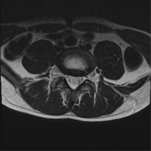 File:Clear cell meningoma - lumbar spine (Radiopaedia 60116-67690 Axial T2 12).png