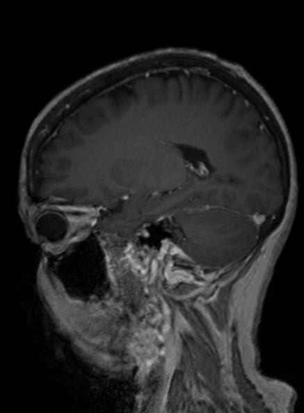 Clival meningioma (Radiopaedia 53278-59248 Sagittal T1 C+ 302).jpg