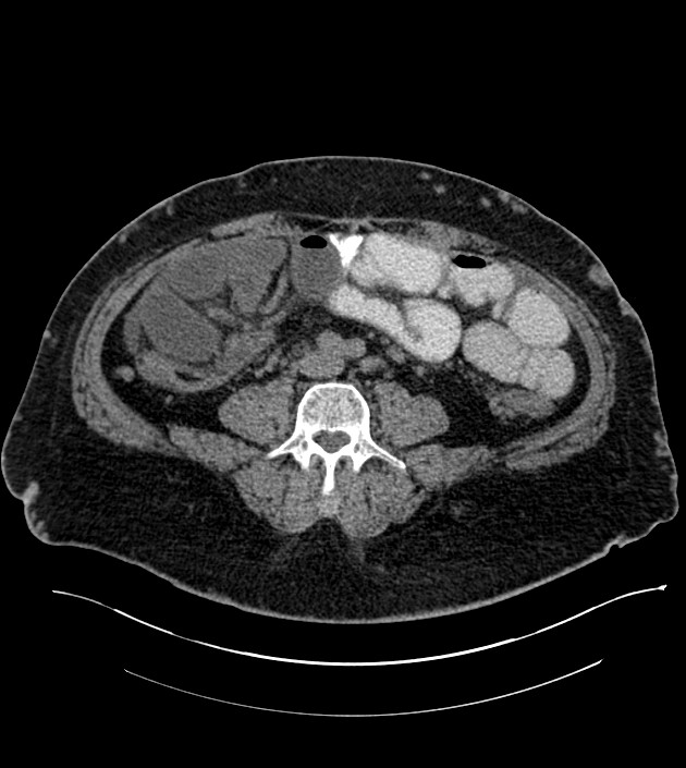 Closed-loop small bowel obstruction-internal hernia (Radiopaedia 78439-91096 Axial non-contrast 95).jpg