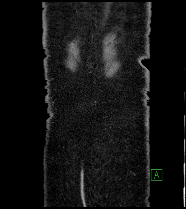 Closed-loop small bowel obstruction-internal hernia (Radiopaedia 78439-91096 Coronal non-contrast 101).jpg