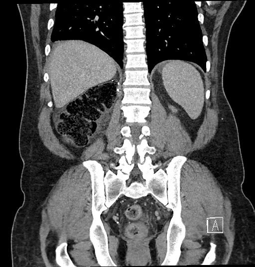 Closed loop obstruction - internal hernia into nephrectomy bed (Radiopaedia 59867-67320 B 103).jpg