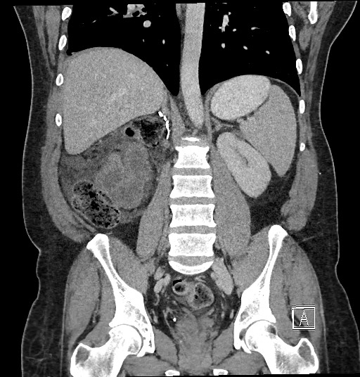 Closed loop obstruction - internal hernia into nephrectomy bed (Radiopaedia 59867-67320 B 90).jpg