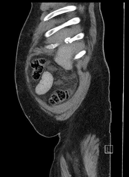 Closed loop obstruction - internal hernia into nephrectomy bed (Radiopaedia 59867-67320 C 102).jpg