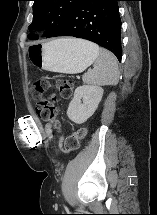 Closed loop obstruction - internal hernia into nephrectomy bed (Radiopaedia 59867-67320 C 16).jpg