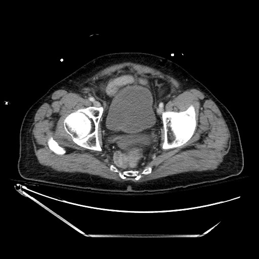 File:Closed loop obstruction due to adhesive band, resulting in small bowel ischemia and resection (Radiopaedia 83835-99023 D 140).jpg