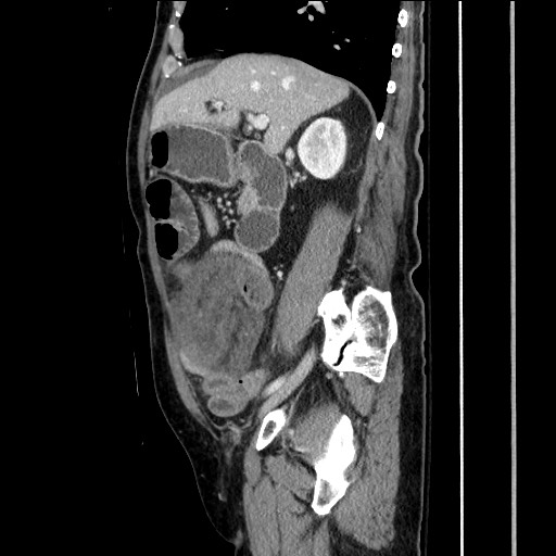 Closed loop obstruction due to adhesive band, resulting in small bowel ischemia and resection (Radiopaedia 83835-99023 F 73).jpg