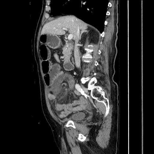 File:Closed loop obstruction due to adhesive band, resulting in small bowel ischemia and resection (Radiopaedia 83835-99023 F 81).jpg