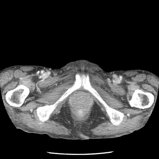 Closed loop small bowel obstruction - adhesions and infarct (Radiopaedia 85125-100678 B 114).jpg