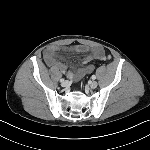 File:Closed loop small bowel obstruction - internal hernia (Radiopaedia 57806-64778 B 97).jpg