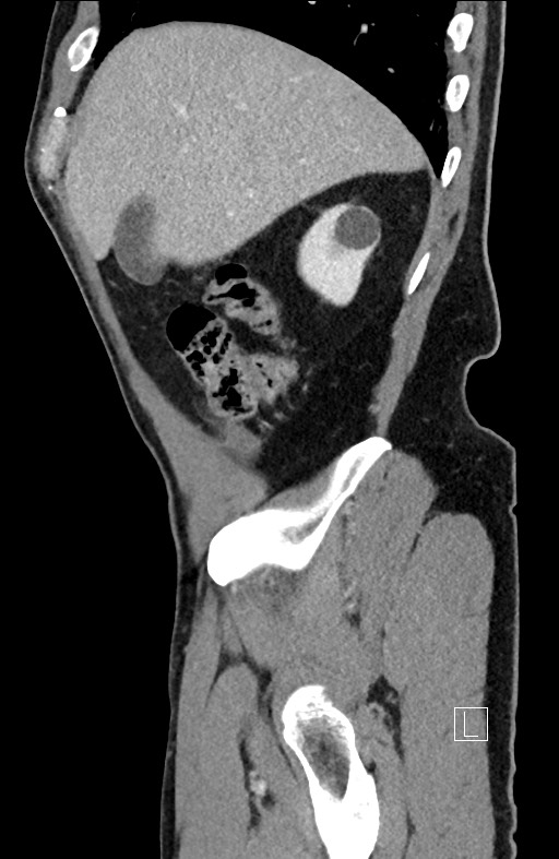 Closed loop small bowel obstruction - internal hernia (Radiopaedia 57806-64778 C 91).jpg