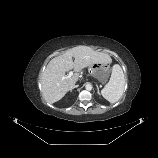 Closed loop small bowel obstruction - internal hernia (Radiopaedia 65402-74450 A 26).jpg