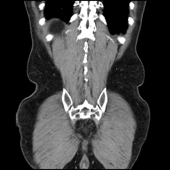 Closed loop small bowel obstruction due to adhesive band - U-shaped loop (Radiopaedia 83829-99012 B 44).jpg