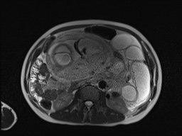 File:Closed loop small bowel obstruction in pregnancy (MRI) (Radiopaedia 87637-104031 Axial T2 34).jpg