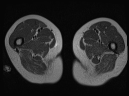 Closed loop small bowel obstruction in pregnancy (MRI) (Radiopaedia 87637-104031 D 55).jpg