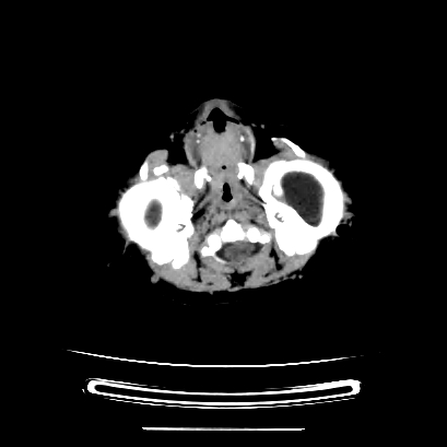 Cloverleaf skull (Radiopaedia 91901-109710 Axial non-contrast 40).jpg