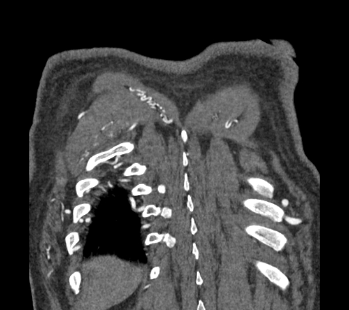 Coarctation of the aorta (Radiopaedia 53752-59822 B 78).jpg