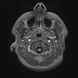 Cochlear incomplete partition type III associated with hypothalamic hamartoma (Radiopaedia 88756-105498 Axial T1 23).jpg
