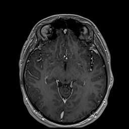 File:Cochlear incomplete partition type III associated with hypothalamic hamartoma (Radiopaedia 88756-105498 Axial T1 C+ 94).jpg