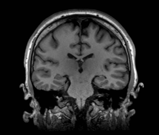 File:Cochlear incomplete partition type III associated with hypothalamic hamartoma (Radiopaedia 88756-105498 Coronal T1 30).jpg