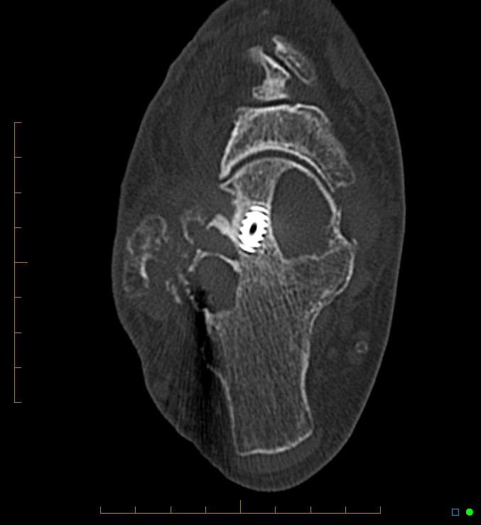 Collapsed total ankle replacement (Radiopaedia 17228-16932 Axial bone window 47).jpg