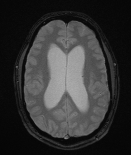 File:Colloid cyst (Radiopaedia 44510-48181 Axial Gradient Echo 17).png