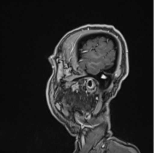 Colloid cyst of the third ventricle (Radiopaedia 86571-102662 Sagittal T1 C+ 70).png