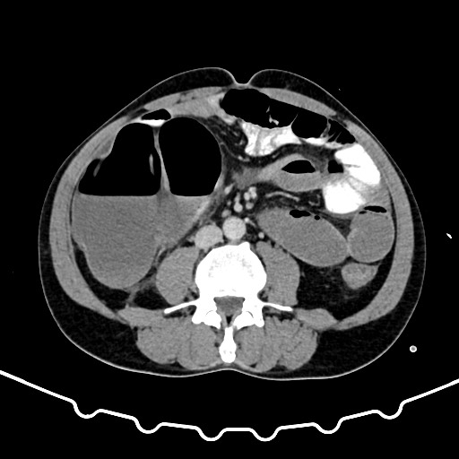Colocolic intussusception due to large lipoma (Radiopaedia 68773-78482 A 104).jpg