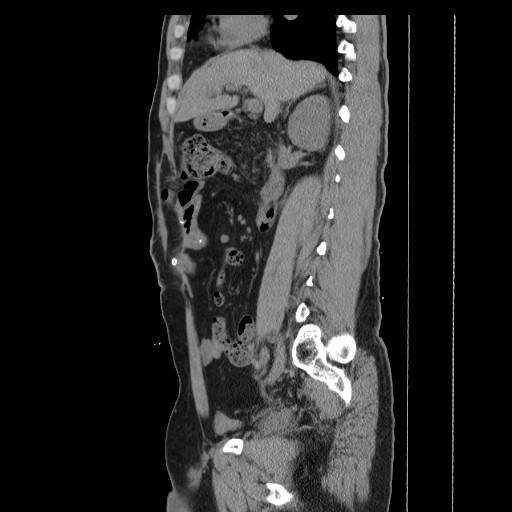 File:Colocutaneous fistula in Crohn's disease (Radiopaedia 29586-30093 C 15).jpg