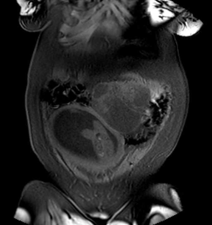 Colon adenocarcinoma with Krukenberg tumors, advanced pregnancy (Radiopaedia 67279-76645 E 13).jpg