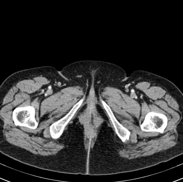 Colon carcinoma with hepatic metastases (Radiopaedia 29477-29961 A 126).jpg