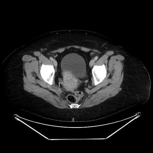 File:Colonic intussusception due to adenocarcinoma (Radiopaedia 86828-102987 A 133).jpg