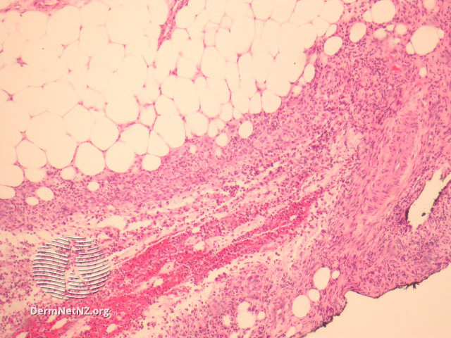 File:Figure 2 (DermNet NZ pathology-e-a1antitrypsin-2).jpg