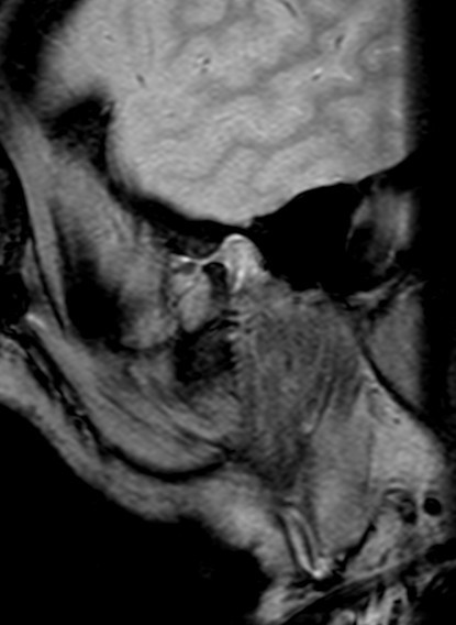 File:Irreducible anterior dislocation - TMJ disc (Radiopaedia 7131).jpg