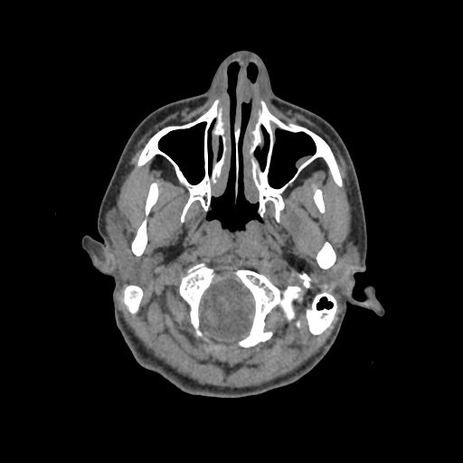File:Nasal pyogenic granuloma (lobular capillary hemangioma) (Radiopaedia 85536-101244 Axial non-contrast 32).jpg