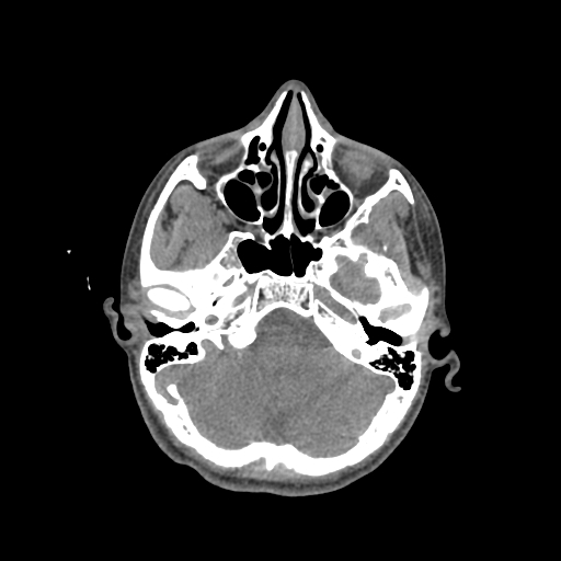 Nasal pyogenic granuloma (lobular capillary hemangioma) (Radiopaedia 85536-101244 Axial non-contrast 76).jpg
