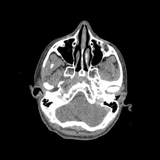 File:Nasal pyogenic granuloma (lobular capillary hemangioma) (Radiopaedia 85536-101244 C 73).jpg
