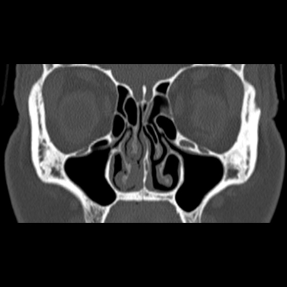 Nasal septal perforation (Radiopaedia 25030-25289 Coronal bone window 30).jpg