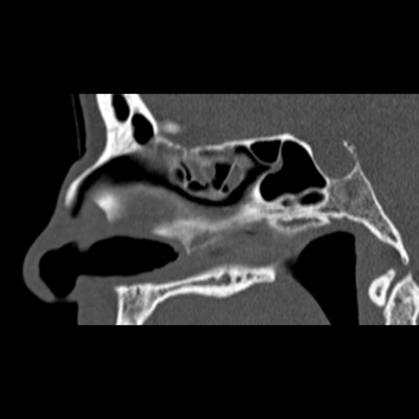 Nasal septal perforation (Radiopaedia 25030-25289 Sagittal bone window 31).jpg