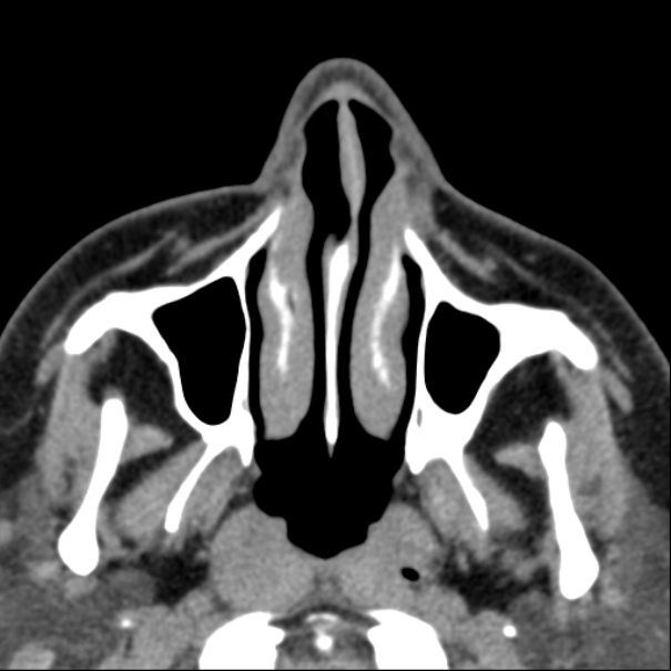 Nasolabial cyst (Radiopaedia 33987-35205 Axial non-contrast 13).jpg