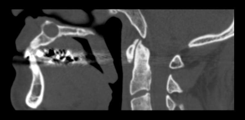 File:Nasopalatine duct cyst (Radiopaedia 11660-12023 Sagittal bone window 1).jpg