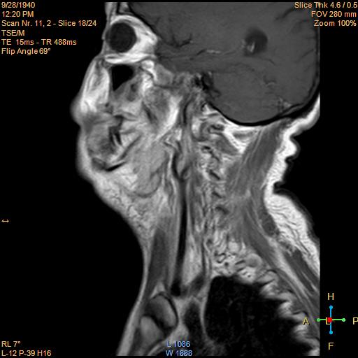 File:Nasopharyngeal carcinoma (Radiopaedia 22375-22403 Sagittal T1 C+ 12).jpg